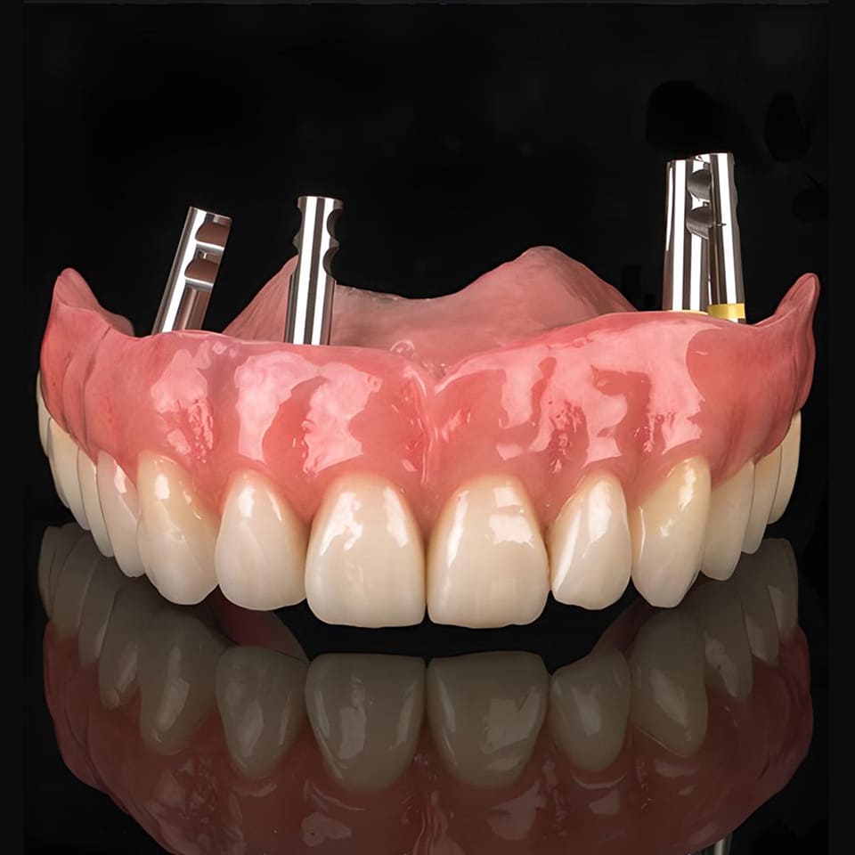 Seniors: How to Find the Cheapest Full Mouth Dental Implants